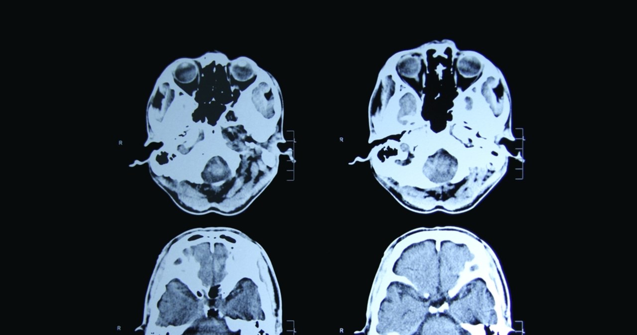 Absolutny przełom w leczeniu choroby Huntingtona