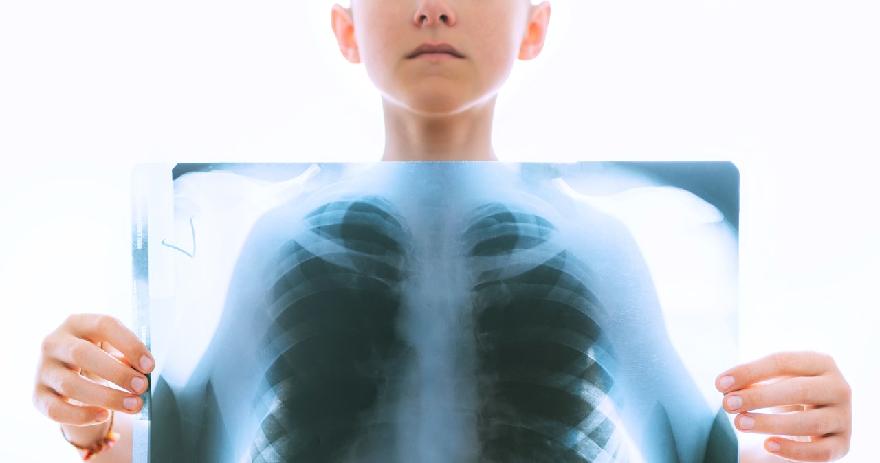 Ponad 180 dzieci przejdzie badania. Miały kontakt z nauczycielką chorą na gruźlicę