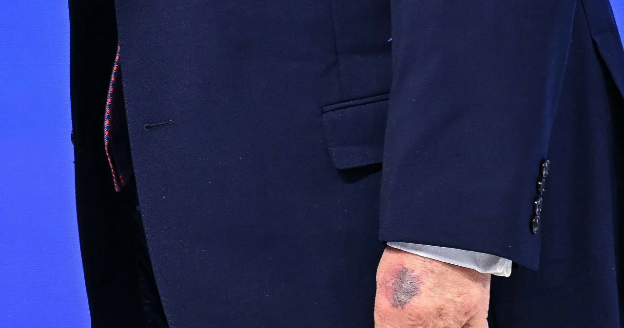 ​Biały Dom wydał oświadczenie ws. siniaka na dłoni Trumpa