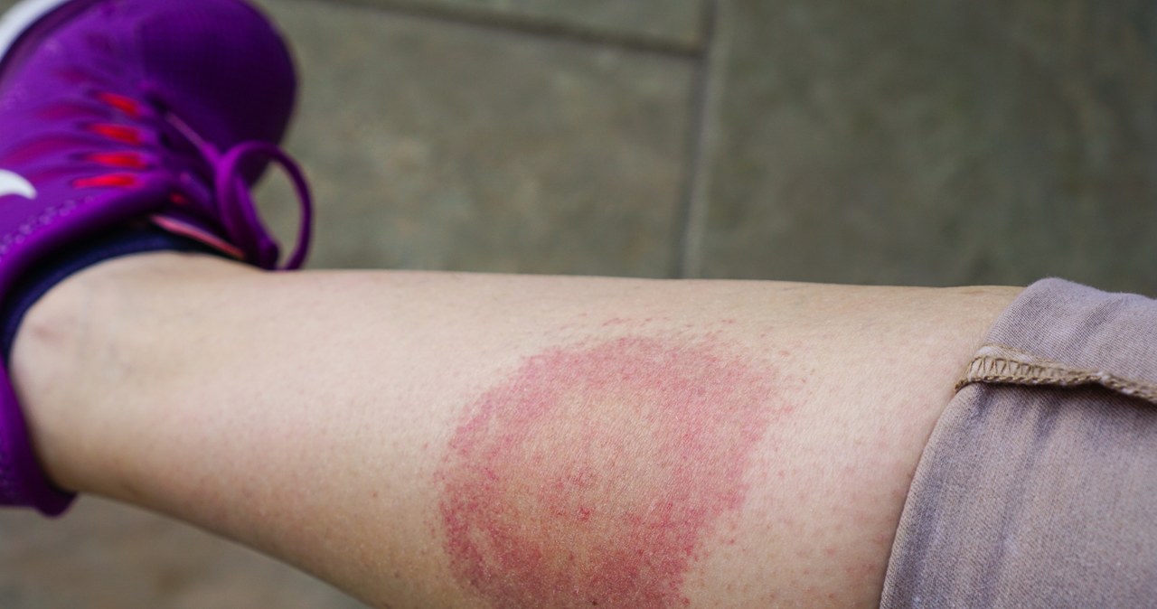 Niepokojące dane z 2024 roku: 100 tys. pacjentów z tymi chorobami