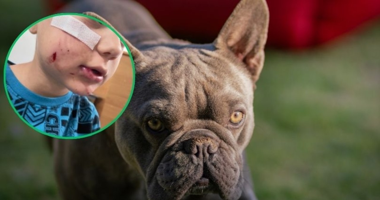 ​Pies pogryzł twarz 4-letniego Frania. Rodzice szukają właściciela czworonoga