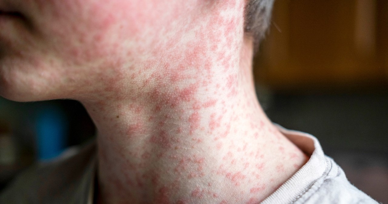 Przypadki odry na Podkarpaciu. Tak wyglądają pierwsze objawy