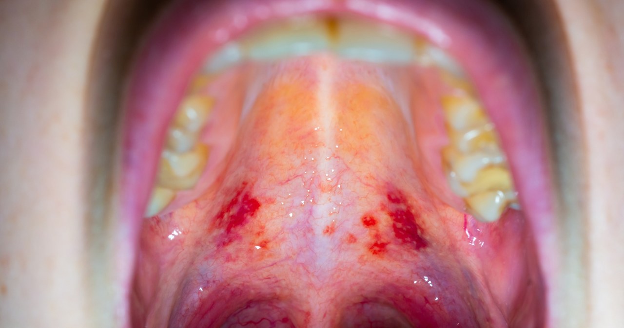 Nowe warianty COVID-19. Nietypowe objawy, "gardło jak pocięte żyletkami"