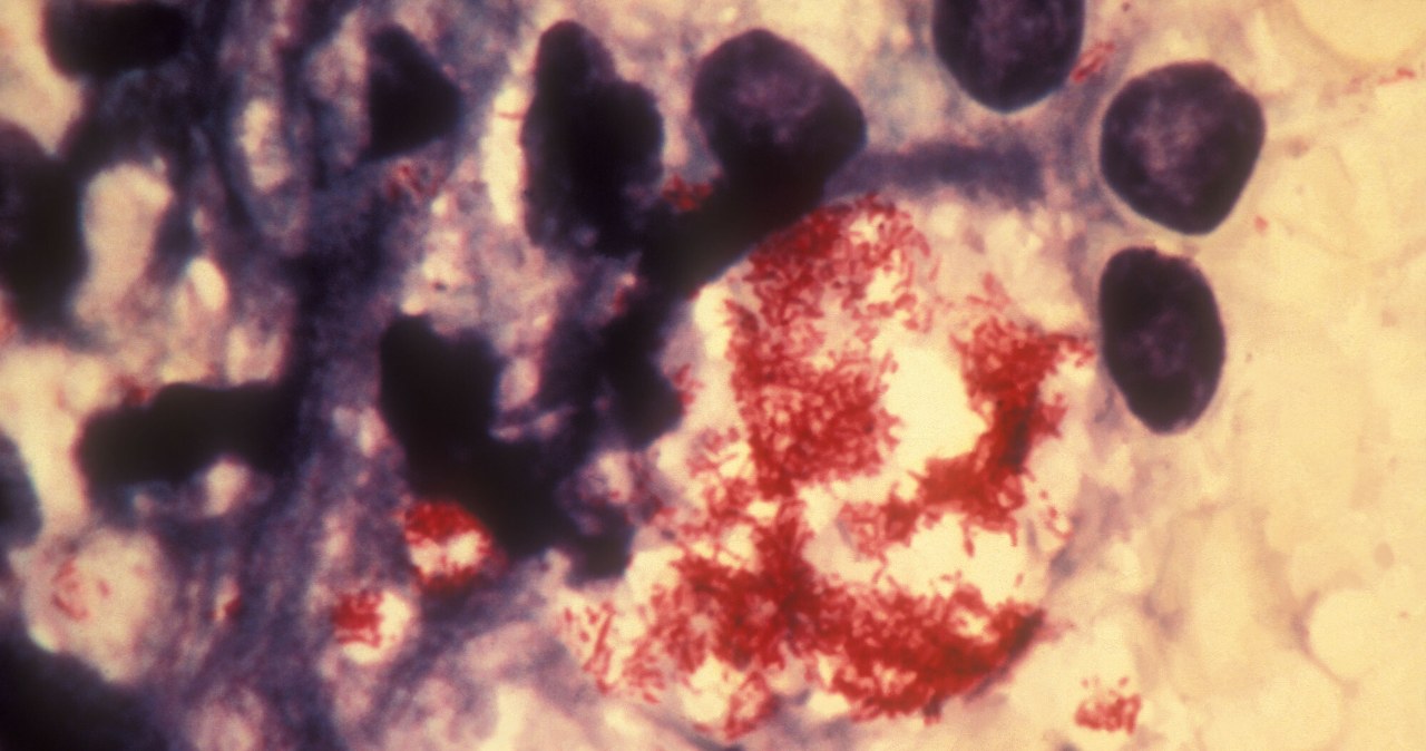 Pracowniczki salonu SPA z trądem. Choroba pojawiła się po ponad 40 latach