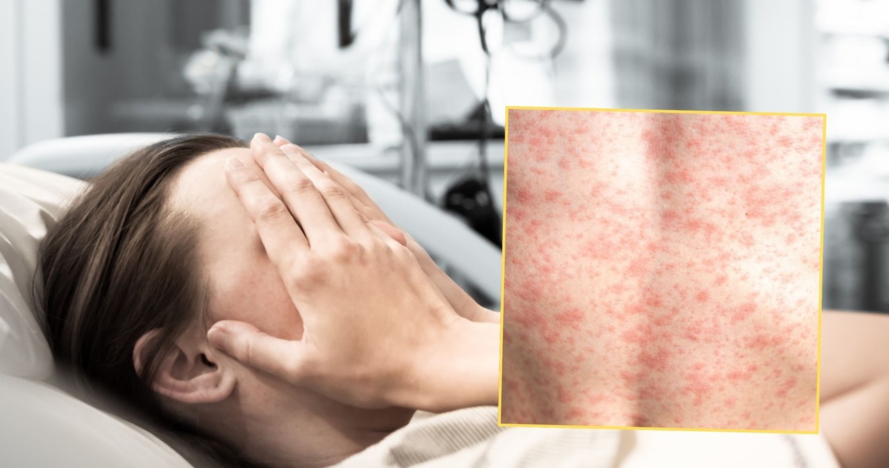 Podejrzewali odrę. Są wyniki badań