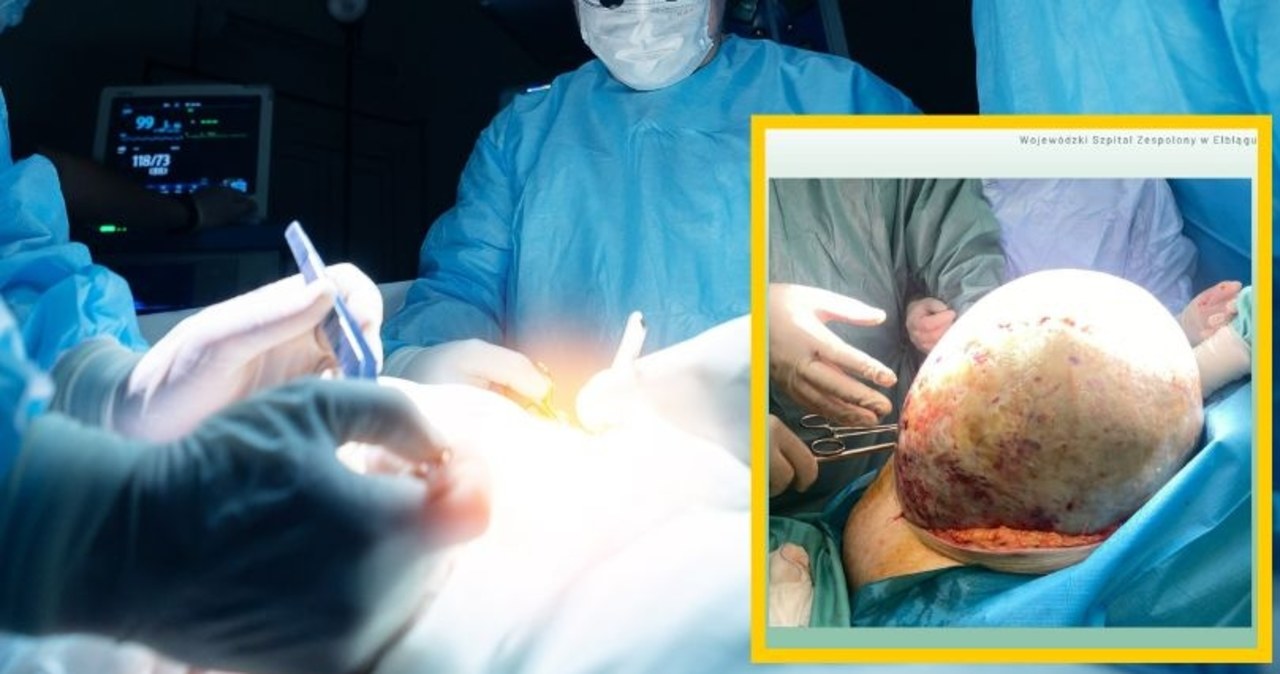 Lekarze usunęli pacjentce 20-kilogramowy guz jajnika