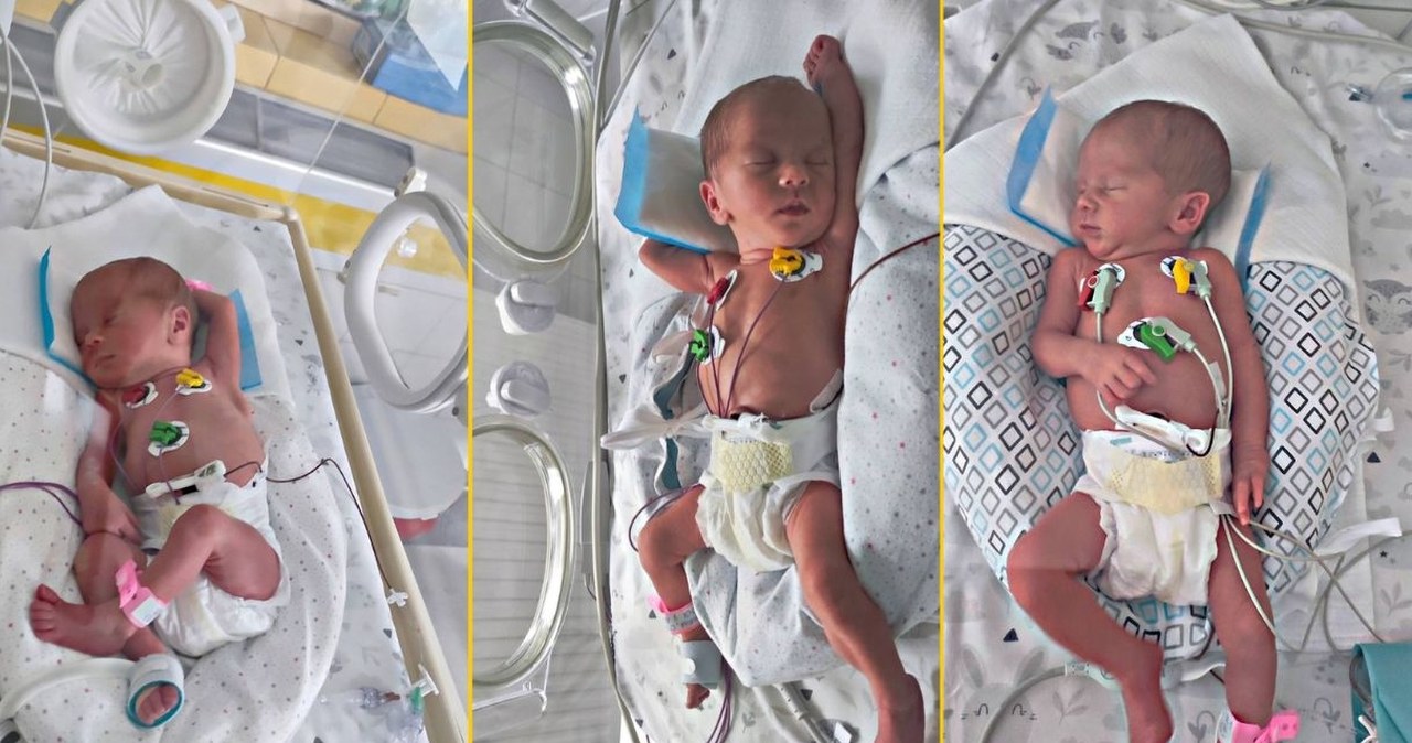 Trojaczki jednojajowe urodziły się w Szczecinie. To rzadki przypadek