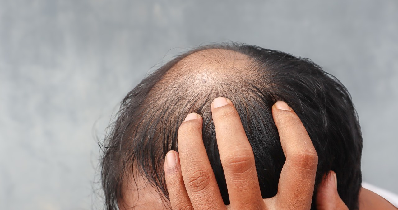 Leczenie łysienia na koszt państwa? Kontrowersyjna propozycja prezydenta