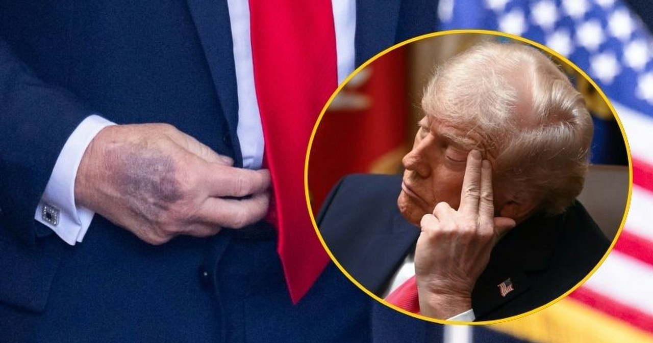Od siniaków po problemy ze snem. Trump o tym, dlaczego ignoruje zalecenia lekarzy