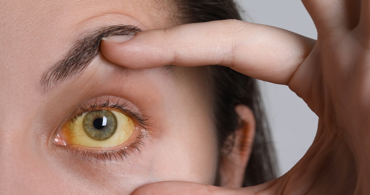 Żółtaczka w szpitalu wojewódzkim. Działania epidemiologiczne w toku