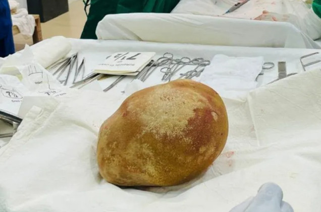 Wyjęli z niego kamień wielkości noworodka. Ta operacja przejdzie do historii